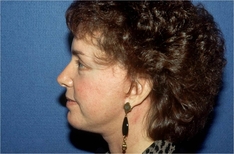 Facelift/Necklift