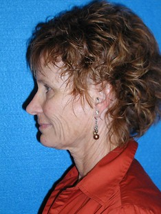 Facelift/Necklift