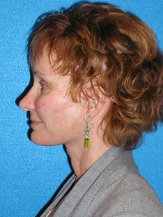 Facelift/Necklift