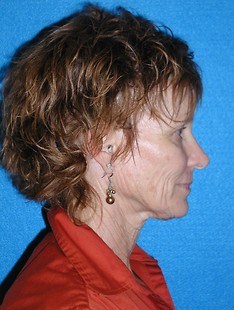 Facelift/Necklift