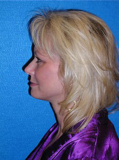 Facelift/Necklift