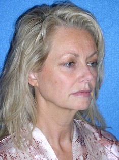 Facelift/Necklift