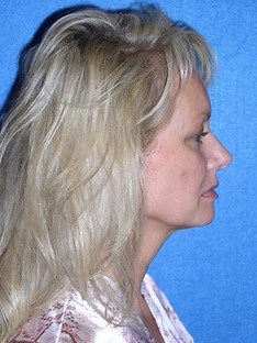 Facelift/Necklift