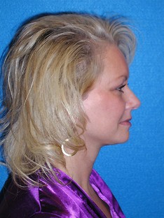 Facelift/Necklift