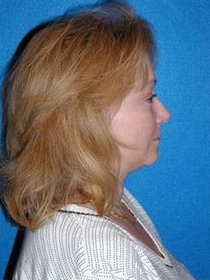 Facelift/Necklift