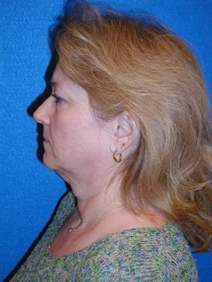 Facelift/Necklift