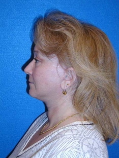 Facelift/Necklift