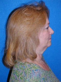 Facelift/Necklift