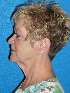 Facelift/Necklift