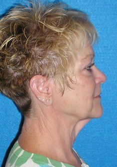 Facelift/Necklift