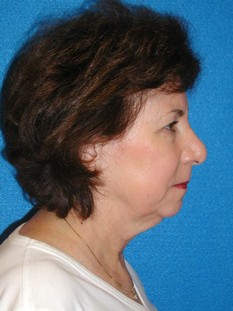 Facelift/Necklift