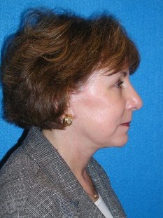 Facelift/Necklift