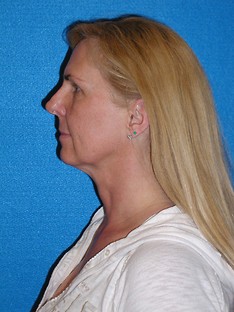 Facelift/Necklift