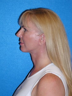 Facelift/Necklift