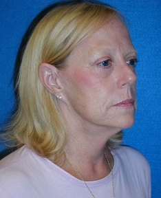 Facelift/Necklift