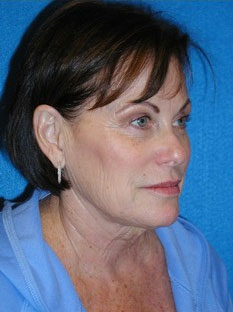 Facelift/Necklift