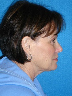 Facelift/Necklift