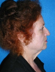 Facelift/Necklift