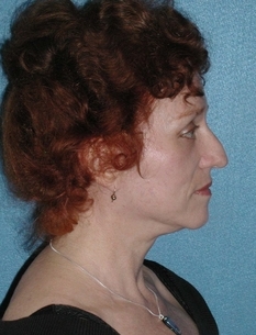 Facelift/Necklift