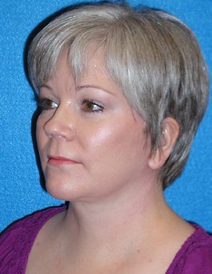 Facelift/Necklift