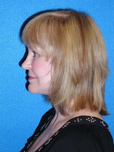 Facelift/Necklift