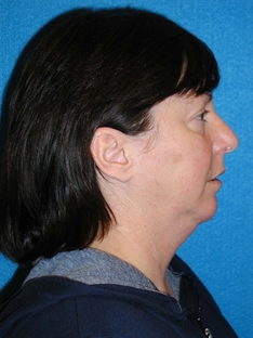 Facelift/Necklift