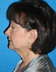 Facelift/Necklift