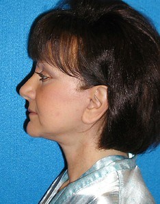 Facelift/Necklift