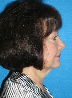 Facelift/Necklift