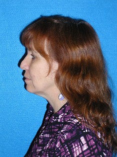 Facelift/Necklift