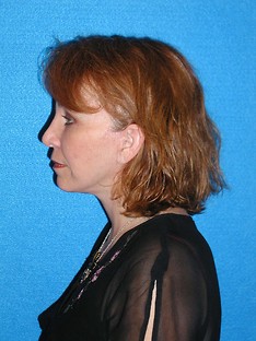 Facelift/Necklift