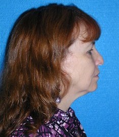 Facelift/Necklift