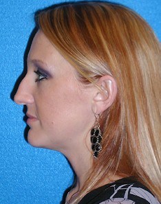 Rhinoplasty