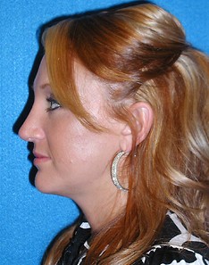 Rhinoplasty