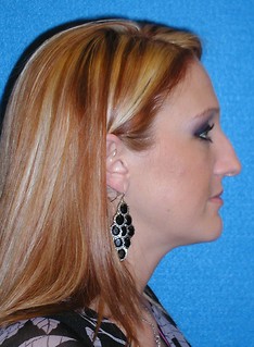 Rhinoplasty