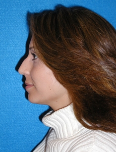 Rhinoplasty