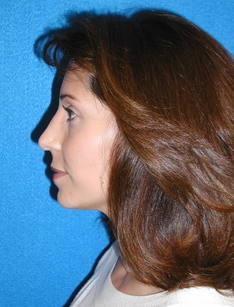 Rhinoplasty