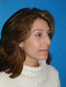 Rhinoplasty