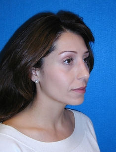 Rhinoplasty