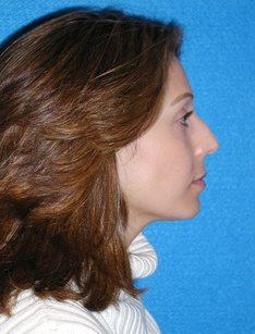 Rhinoplasty