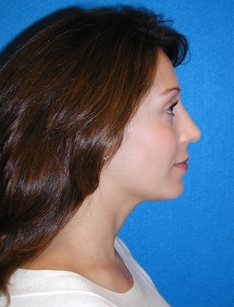 Rhinoplasty