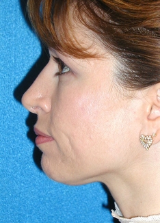 Rhinoplasty