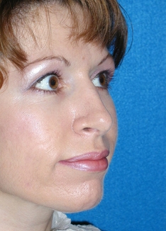 Rhinoplasty