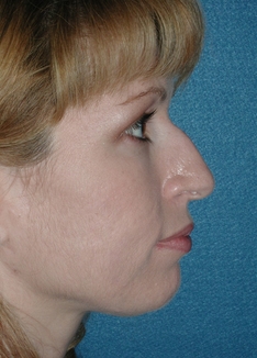 Rhinoplasty