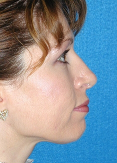 Rhinoplasty