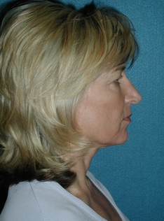 Rhinoplasty