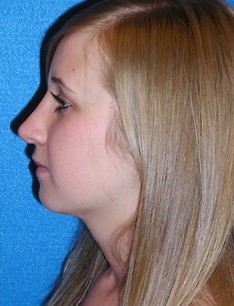 Rhinoplasty