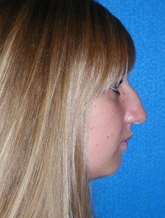 Rhinoplasty