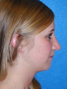 Rhinoplasty