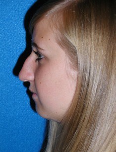 Rhinoplasty